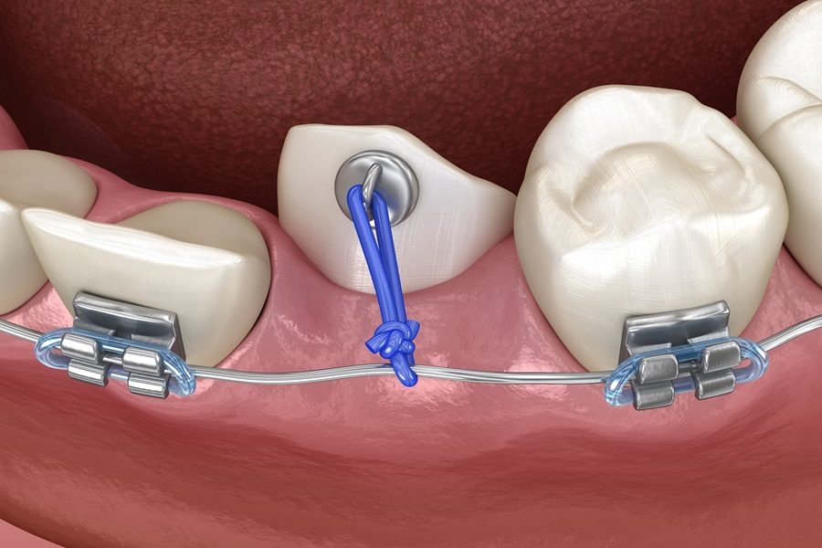 Impacted,Cuspid,And,Elastic,For,Correction.,Medically,Accurate,Dental,3d