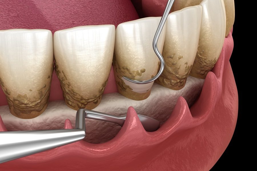 Open,Curettage:,Scaling,And,Root,Planing,(conventional,Periodontal,Therapy).,Medically