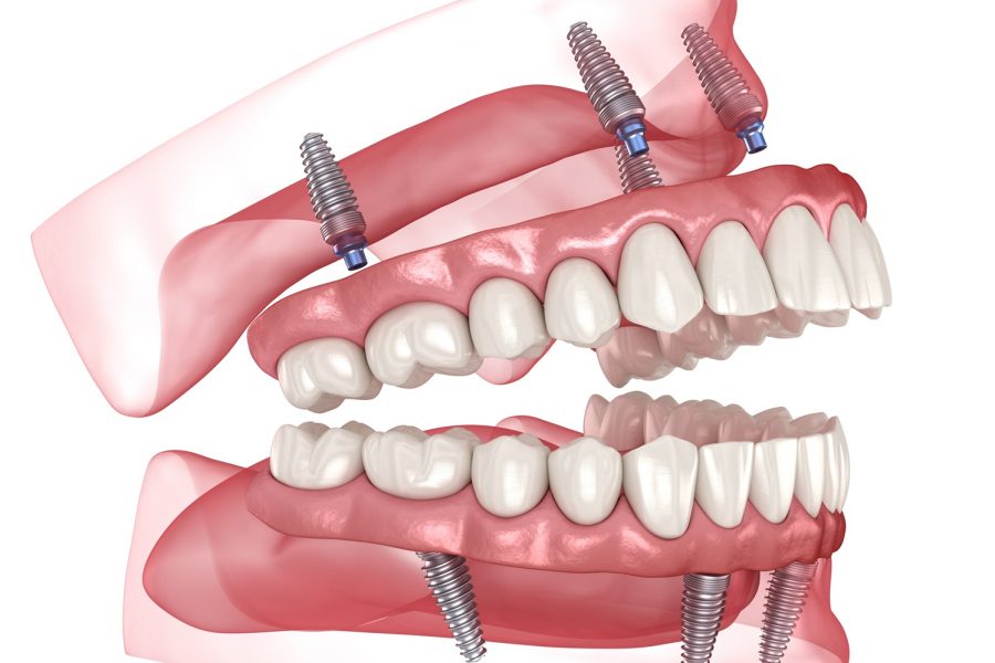 Dental,Prosthesis,Based,On,4,Implants.,Dental,3d,Illustration